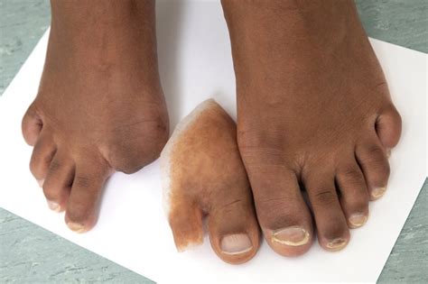 prosthetics for amputated toes